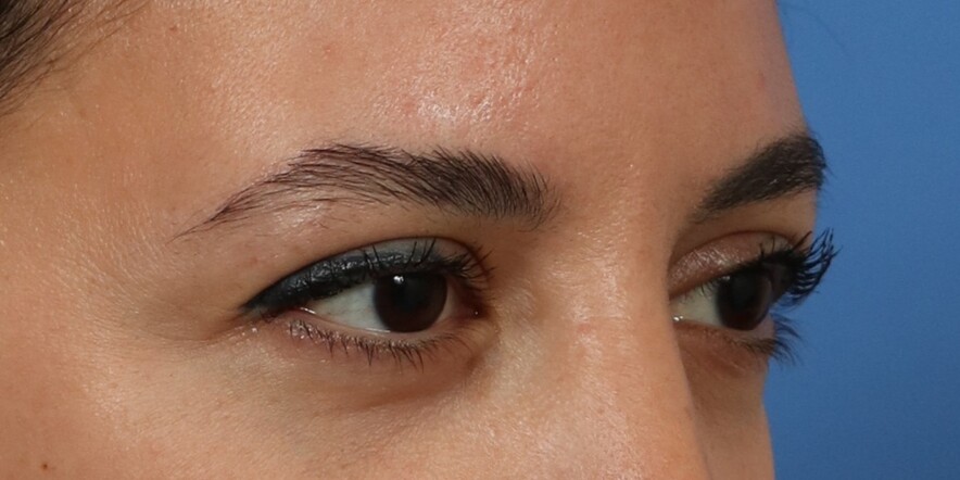 Eyelid Lift Before & After Image