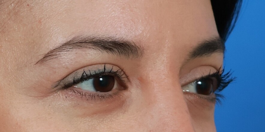 Eyelid Lift Before & After Image