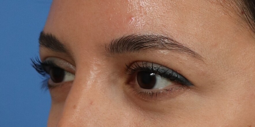 Eyelid Lift Before & After Image
