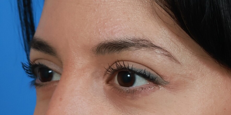 Eyelid Lift Before & After Image