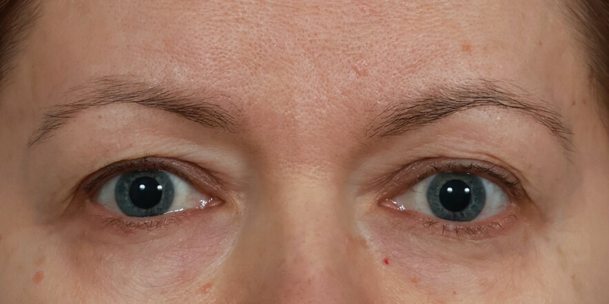 Eyelid Lift Before & After Image