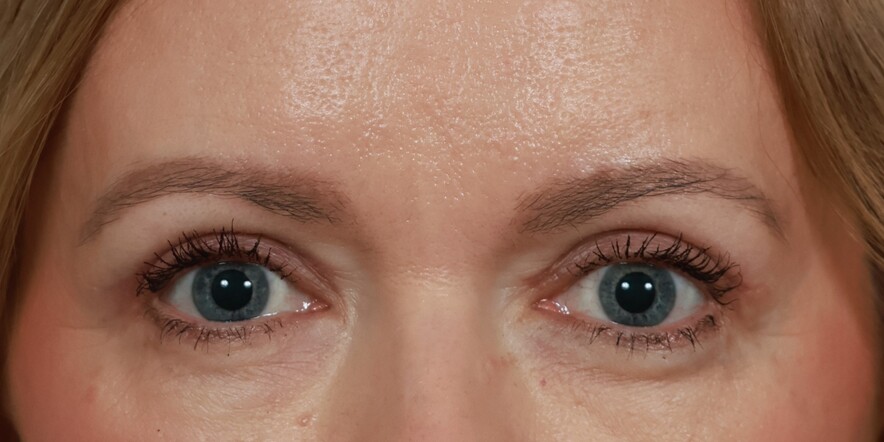 Eyelid Lift Before & After Image