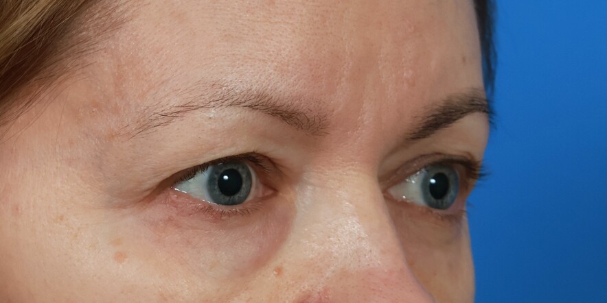 Eyelid Lift Before & After Image