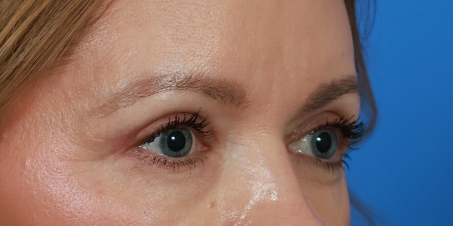 Eyelid Lift Before & After Image