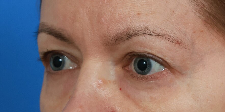 Eyelid Lift Before & After Image