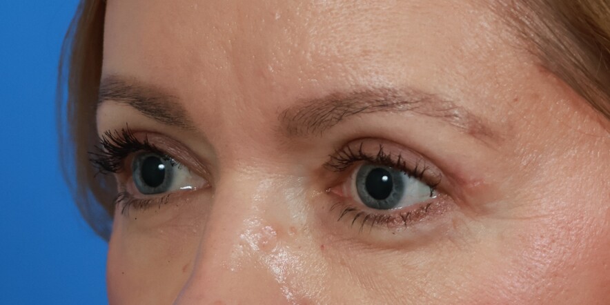 Eyelid Lift Before & After Image