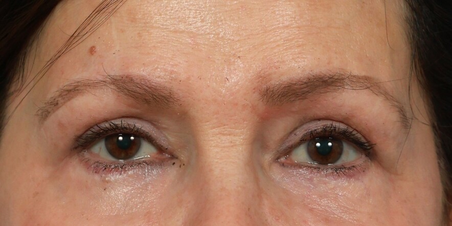 Eyelid Lift Before & After Image