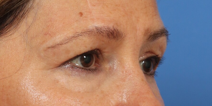 Eyelid Lift Before & After Image