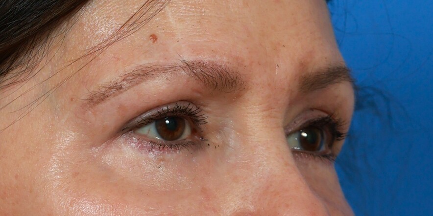Eyelid Lift Before & After Image