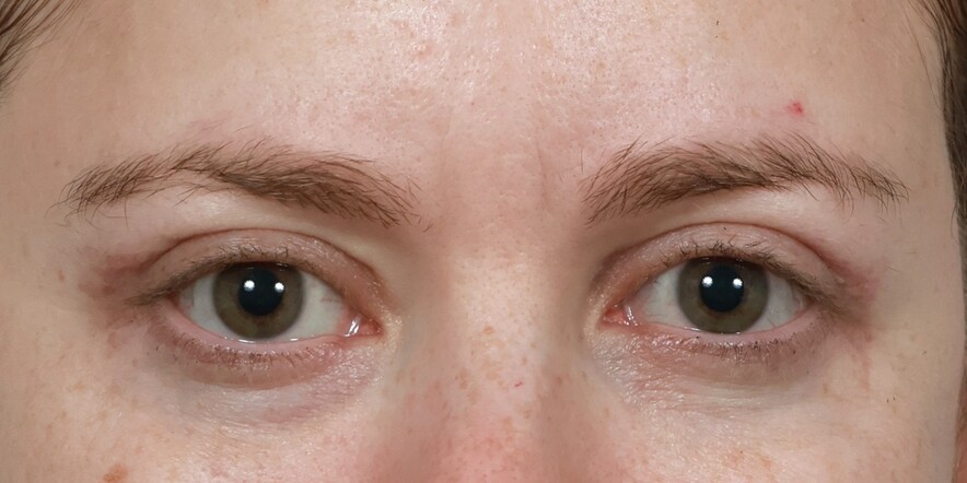 Eyelid Lift Before & After Image