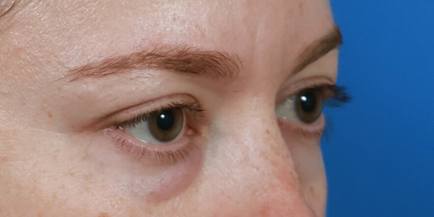 Eyelid Lift Before & After Image