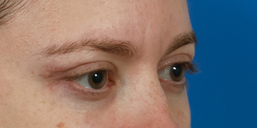 Eyelid Lift Before & After Image