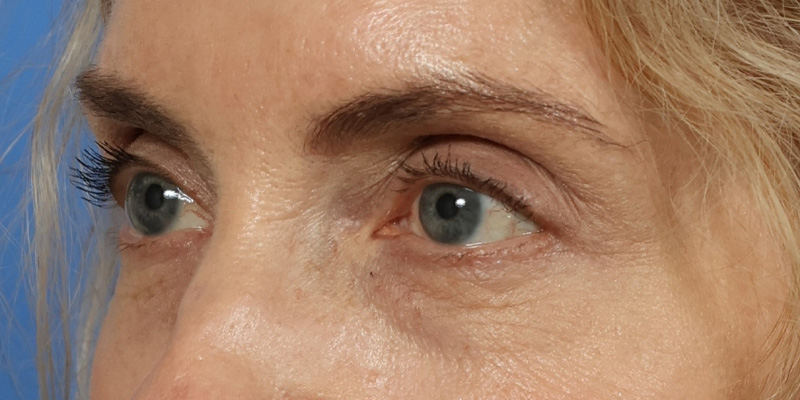 Eyelid Lift Before & After Image