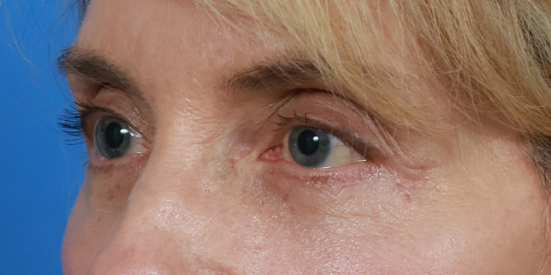 Eyelid Lift Before & After Image