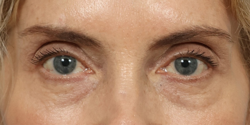 Eyelid Lift Before & After Image