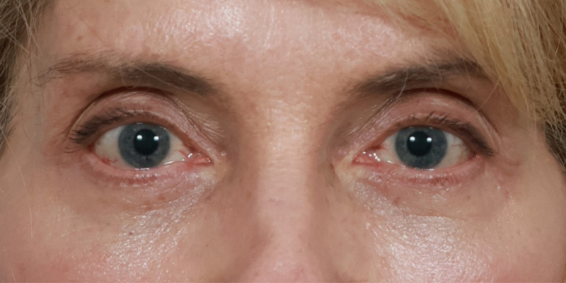 Eyelid Lift Before & After Image