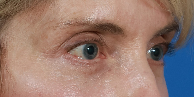 Eyelid Lift Before & After Image