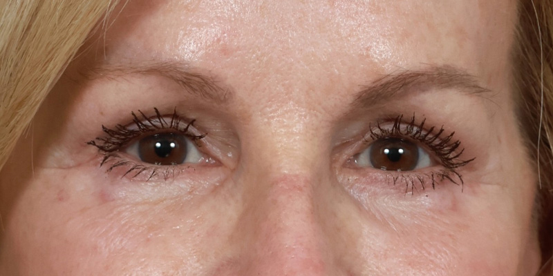 Eyelid Lift Before & After Image