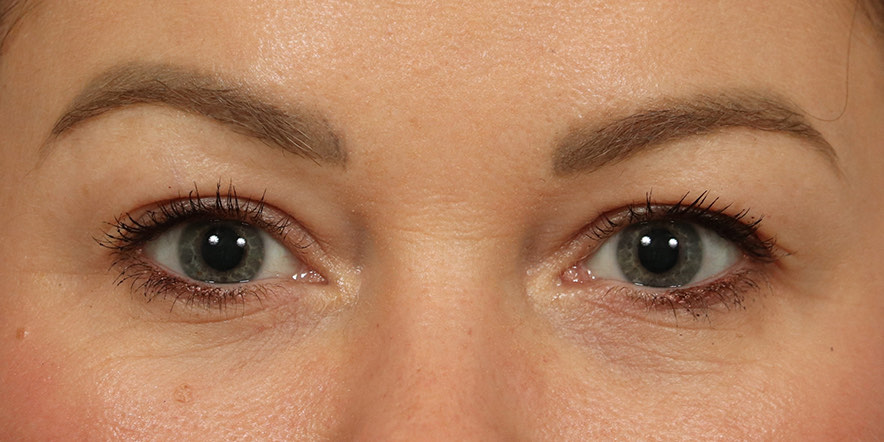 Eyelid Lift Before & After Image