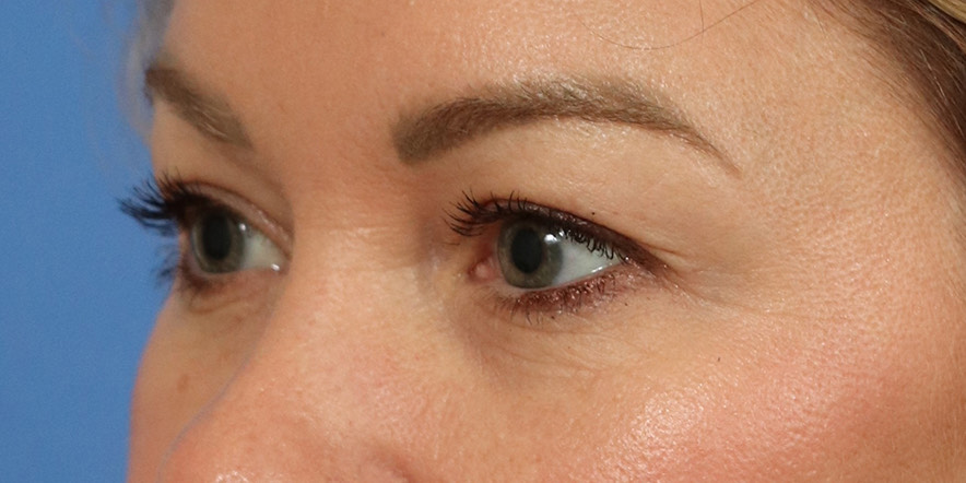 Eyelid Lift Before & After Image