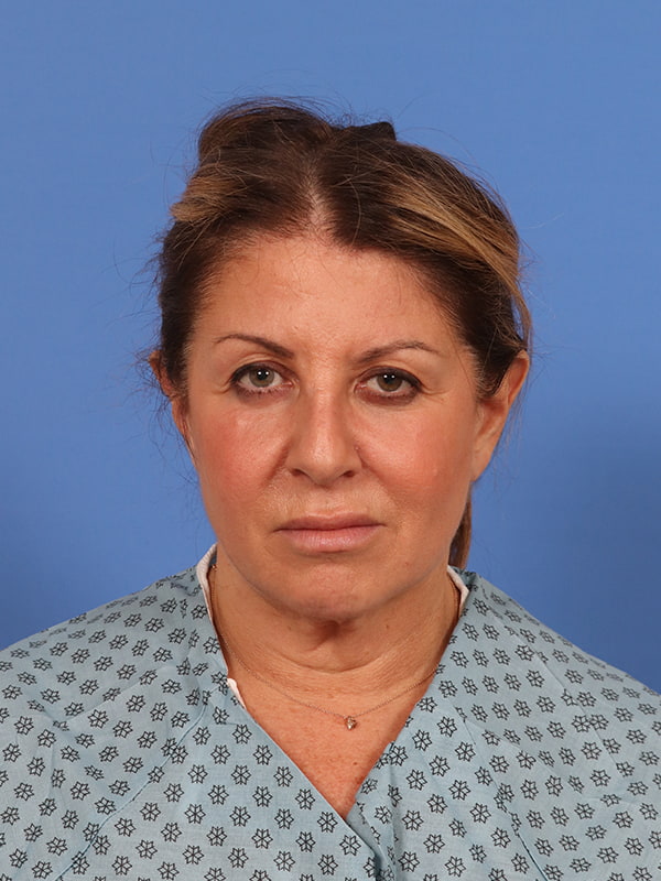Face & Neck Lift Before & After Image
