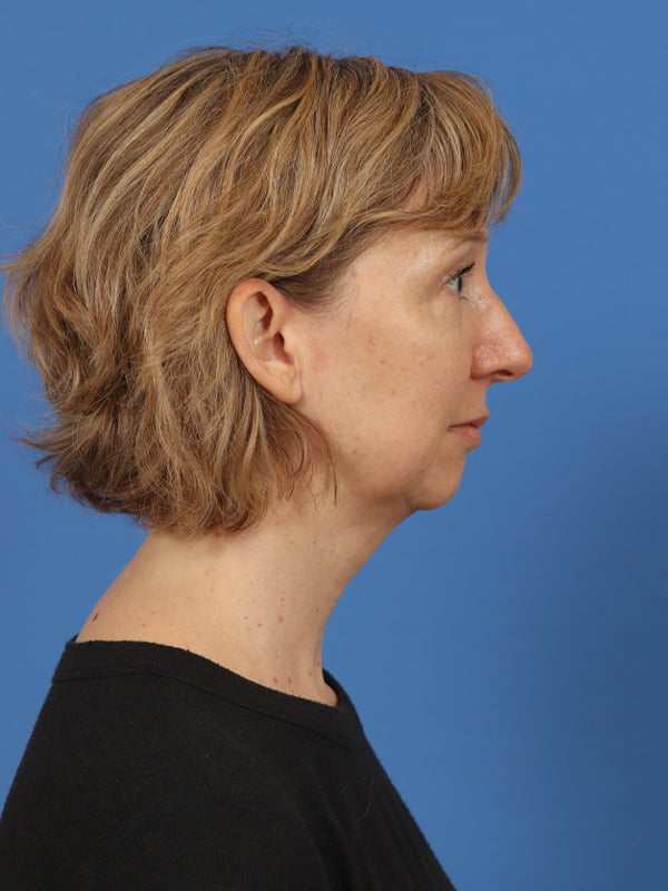 Face & Neck Lift Before & After Image