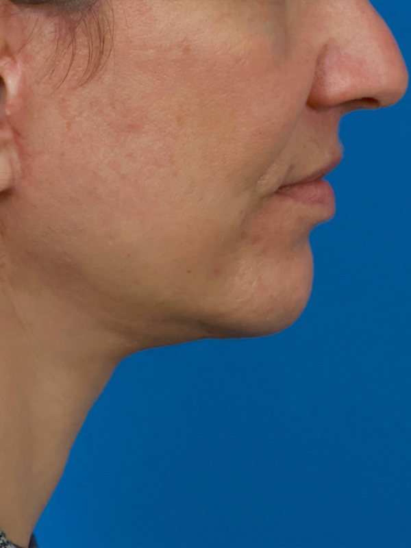 Face & Neck Lift Before & After Image
