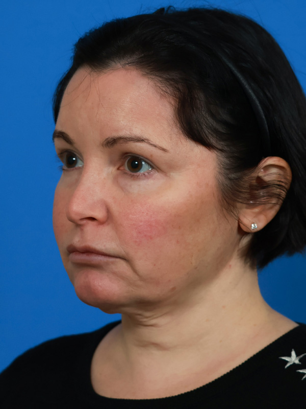 Face & Neck Lift Before & After Image