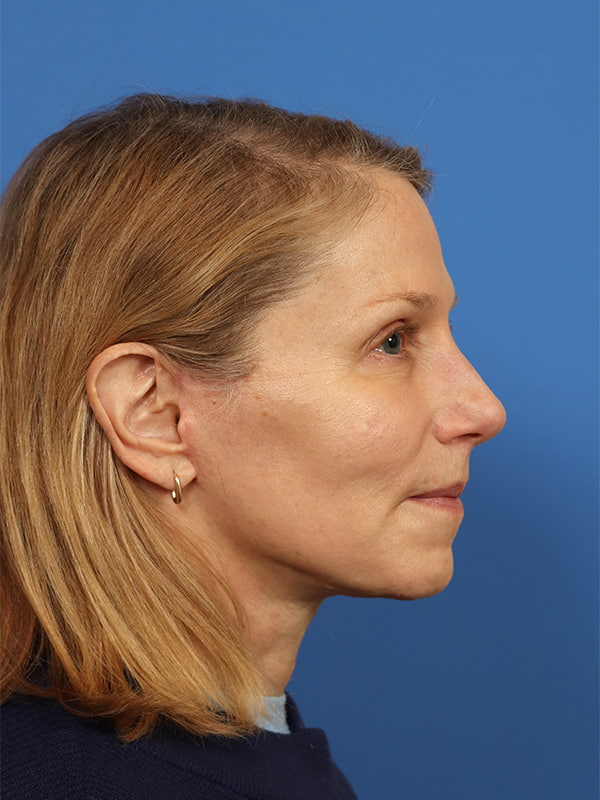 Face & Neck Lift Before & After Image
