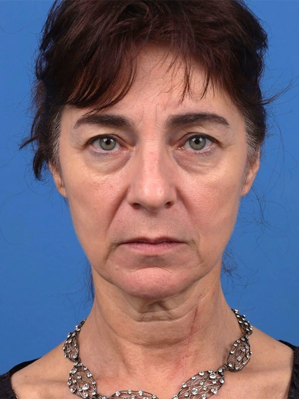 Face & Neck Lift Before & After Image