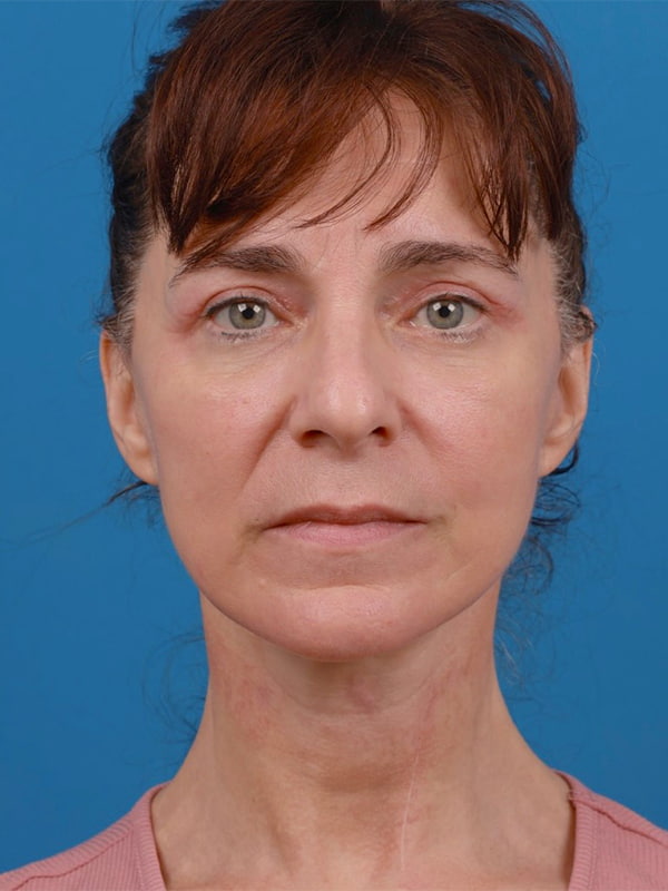 Face & Neck Lift Before & After Image