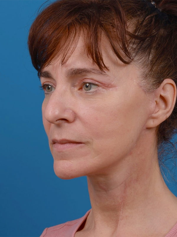 Face & Neck Lift Before & After Image
