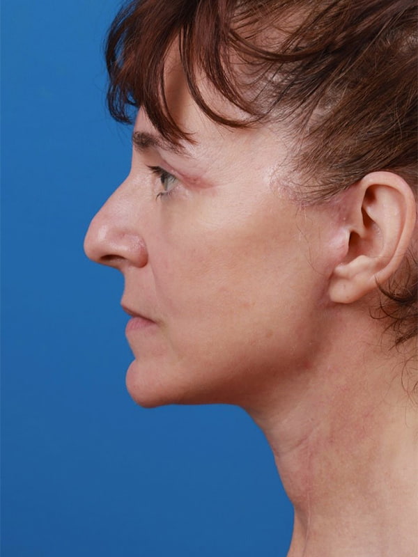 Face & Neck Lift Before & After Image