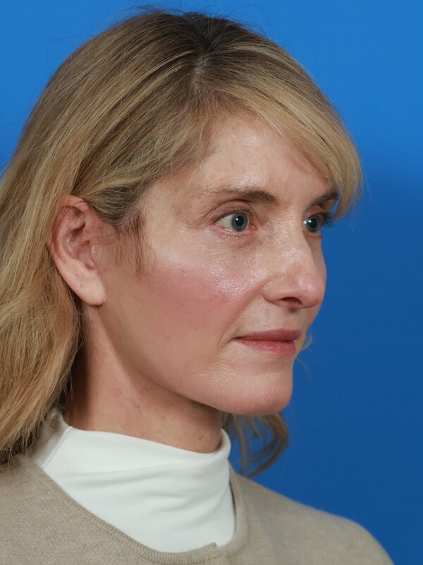 Facelift Before & After Image