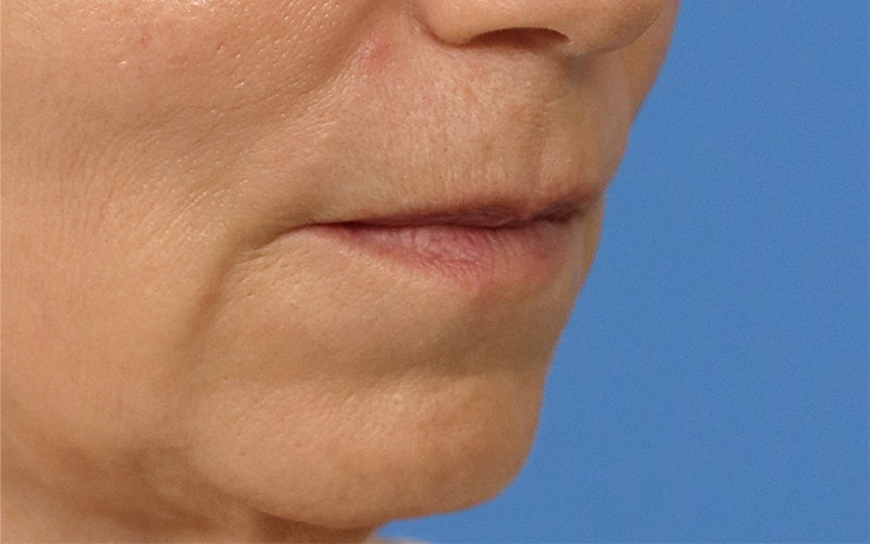Lip lift Before & After Image