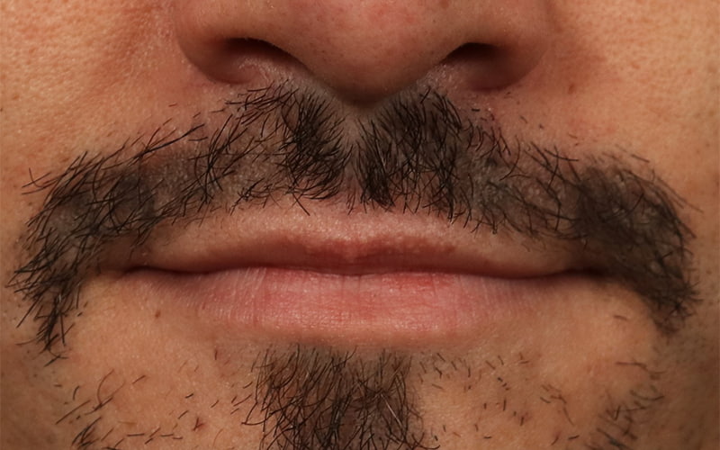 Lip Lift Before & After Image