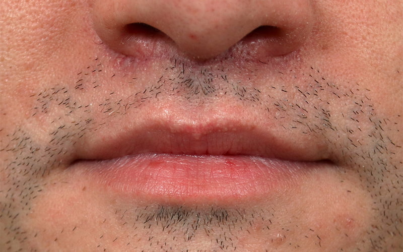 Lip Lift Before & After Image