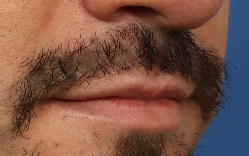 Lip Lift Before & After Image