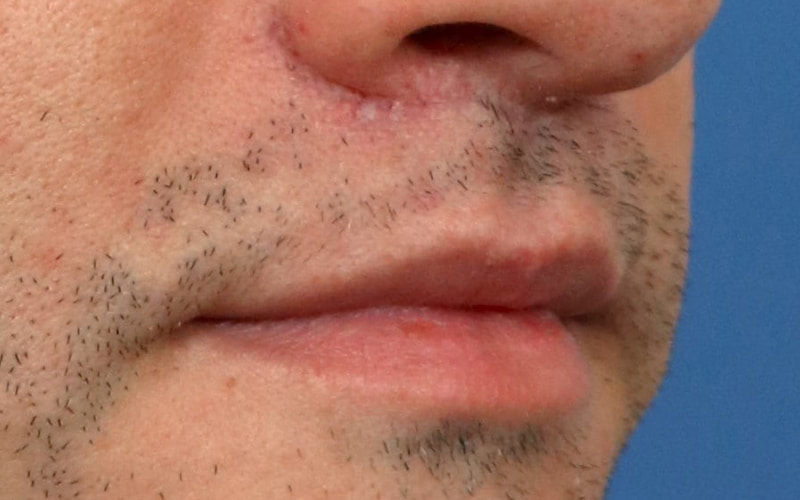 Lip Lift Before & After Image