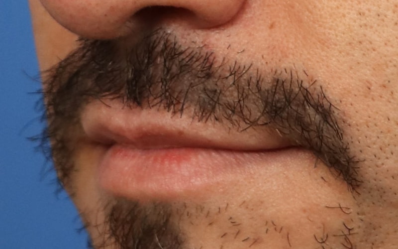 Lip Lift Before & After Image