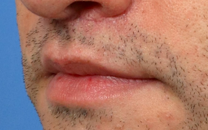 Lip Lift Before & After Image
