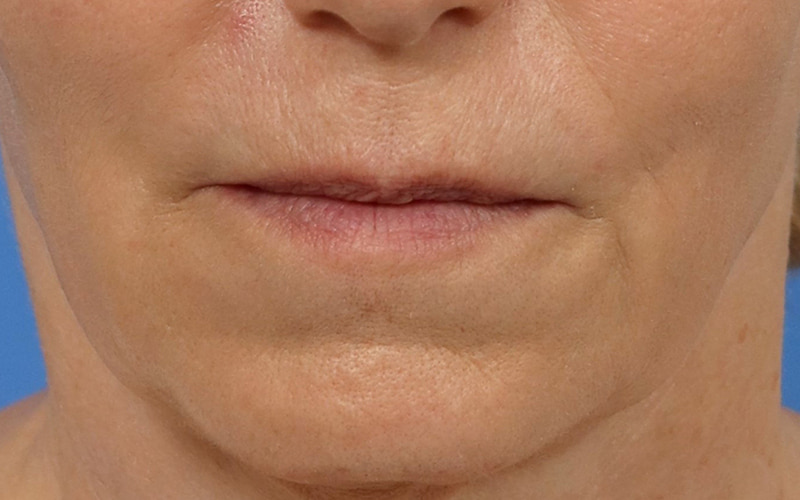 Lip Lift Before & After Image