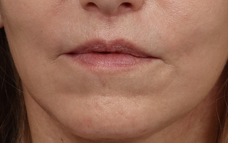 Lip Lift Before & After Image