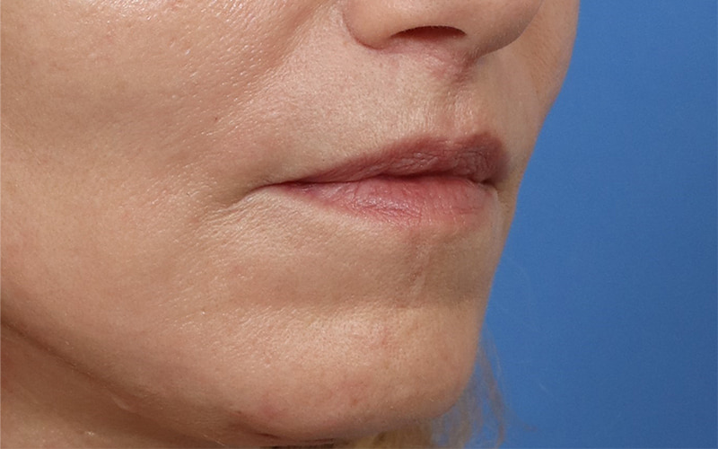 Lip lift Before & After Image