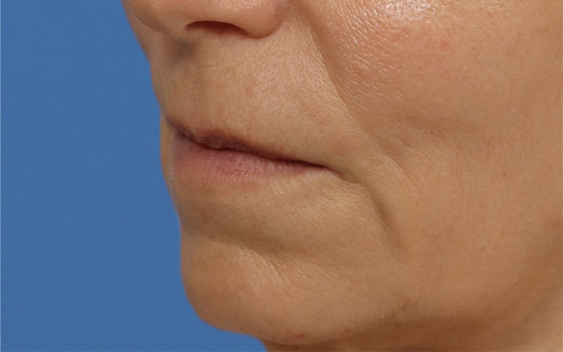 Lip lift Before & After Image