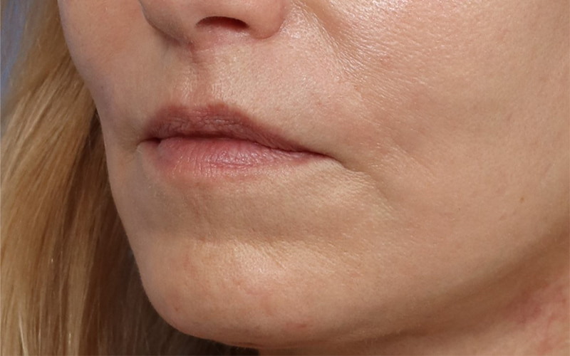 Lip lift Before & After Image