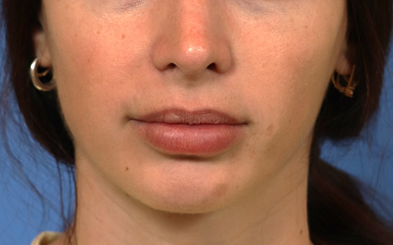 Lip Lift Before & After Image