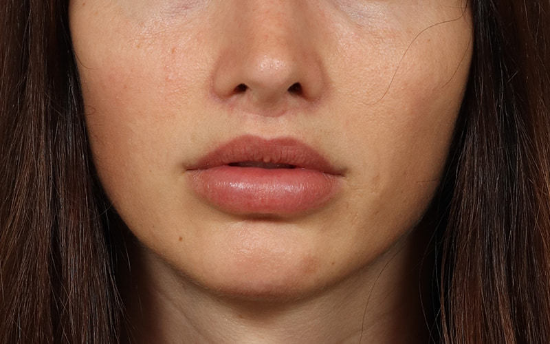 Lip Lift Before & After Image