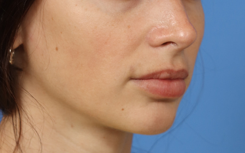 Lip Lift Before & After Image