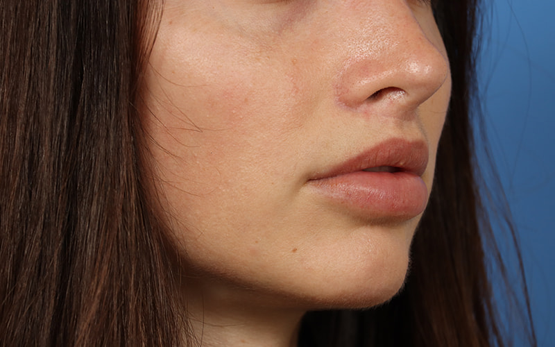 Lip Lift Before & After Image